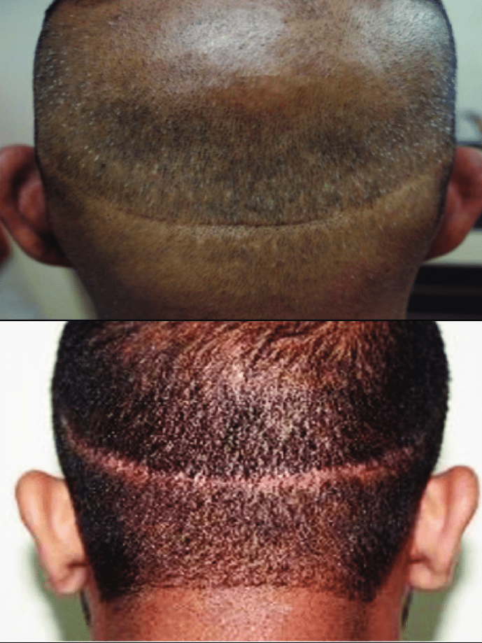 Haartransplantation Archive Haarausfall Stoppen