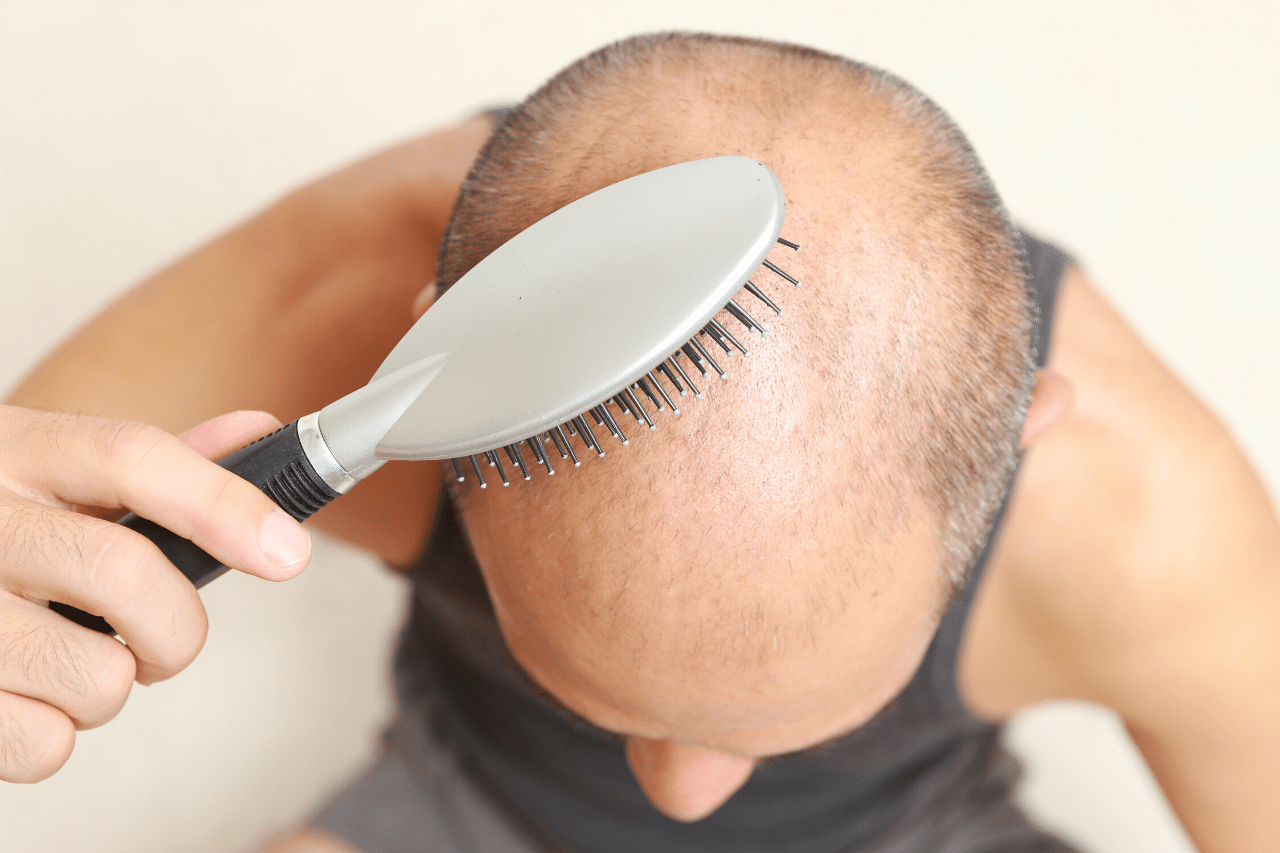 Warum haben Männer Haarausfall und bekommen eine Glatze