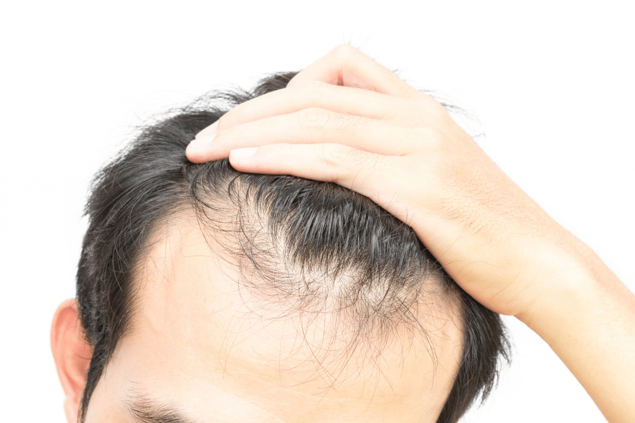 Norwood-Skala Die sieben Stadien des Haarausfalls bei Männern